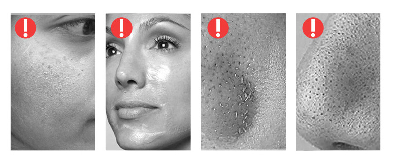 Lifting and tightening ultrasonic ions promote collagen production and introduce blackhead rejuvenation exfoliating pore  extractor (second generation)