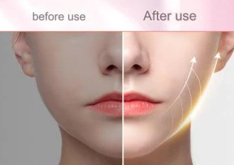 Lifting and tightening ultrasonic ions promote collagen production and introduce blackhead rejuvenation exfoliating pore  extractor (second generation)