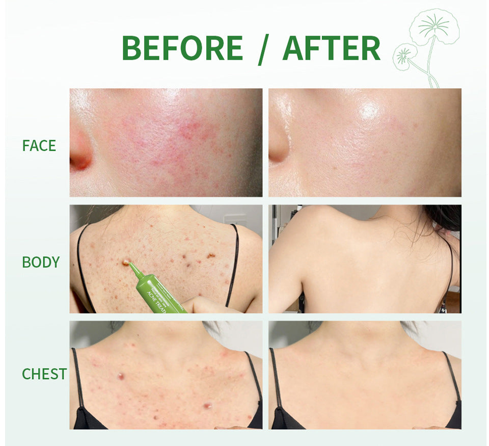 Centella asiatica extract pore shrinking, anti-inflammatory and acne repair solution